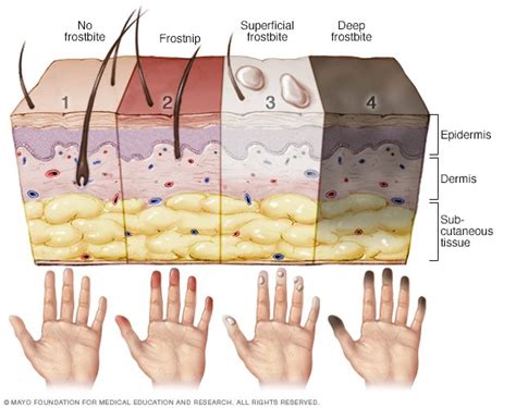 Stages of frostbite - Mayo Clinic