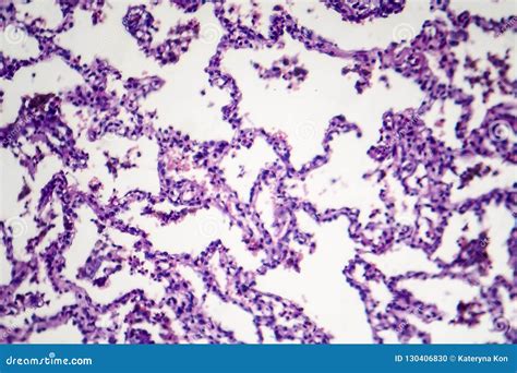 Lobar Pneumonia Histology