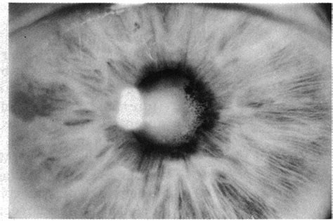 Case 6. Posterior synechiae after repeated episodes ofanterior uveitis ...