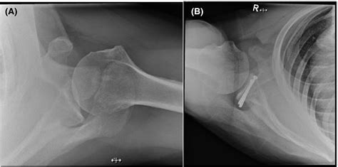 Scapula Anatomy Xray