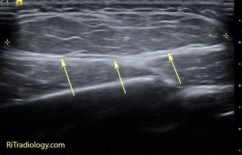 RiT radiology: Soft Tissue Lipoma