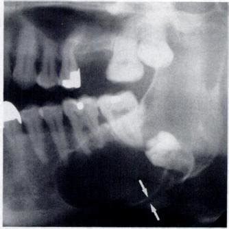 -Dentigerous cyst. Panoramic radiograph of posterior area of mandible ...