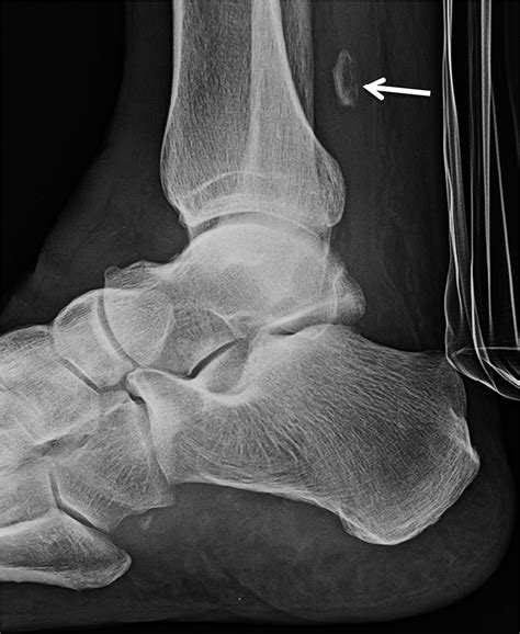 Lateral radiograph of the right ankle obtained in January 2017 ...