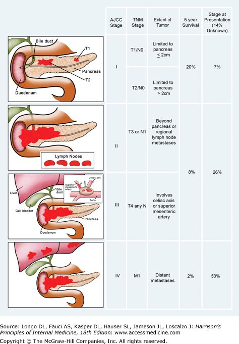 stages of pancreatic cancer