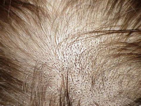 What Are The Signs Of New Hair Growth? - Lewigs