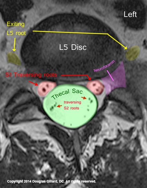 Spinal Nerve Roots Exit