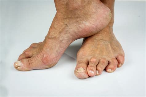 Foot Problems You May Experience as You Age | Nagy Footcare