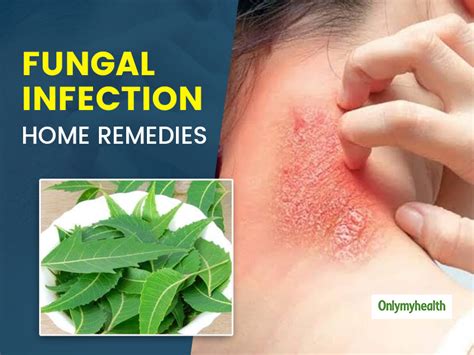 Fungal Skin Infection Bothering You? Here Are 5 Home Remedies To Get ...