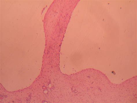 MENISCAL CYST – Histopathology.guru