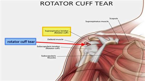 Rotator cuff injury causes, signs, symptoms, diagnosis and treatment