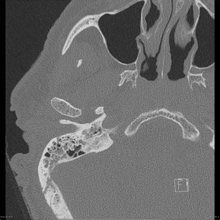 Petrous Temporal Bone Fracture