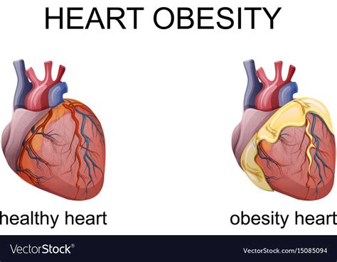 Obesity heart Royalty Free Vector Image - VectorStock