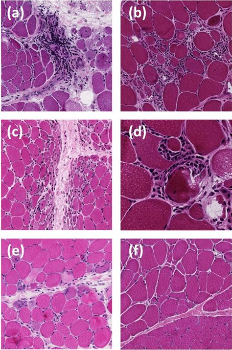 Pathology features for myositis diagnosis. Several biopsy features ...