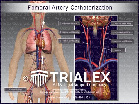 Femoral Artery Catheterization - TrialQuest Inc.