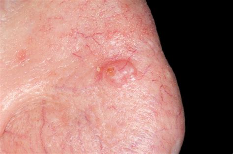 Basal Cell Carcinoma Of The Nose Photograph by Dr P. Marazzi/science ...