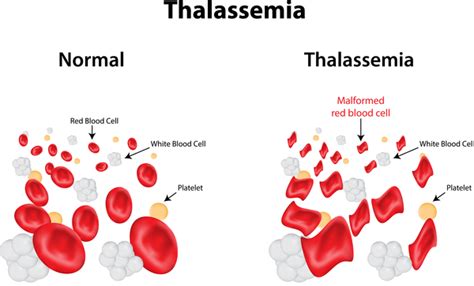 Alpha thalassemia: MedlinePlus Genetics