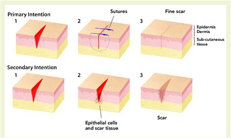 Difference in wound healing between primary and secondary intention ...