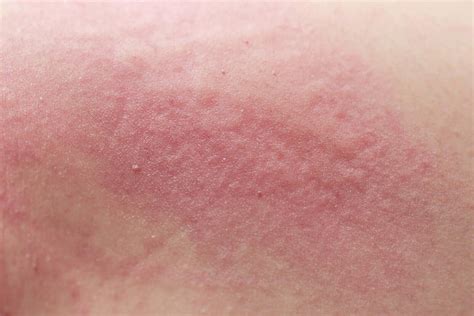 Scabies in Children: Symptoms, Causes and Treatment - You are Mom