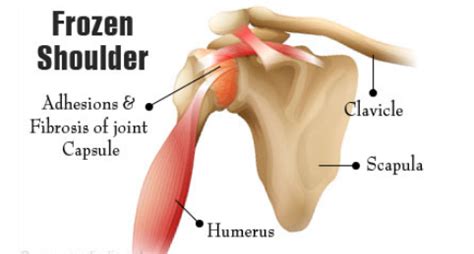 Frozen Shoulder Symptoms, Causes, &Treatments - OrthofootMD