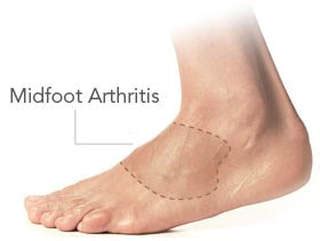 MIDFOOT ARTHRITIS - WESTERN CAROLINA ORTHOTICS AND PROSTHETICS