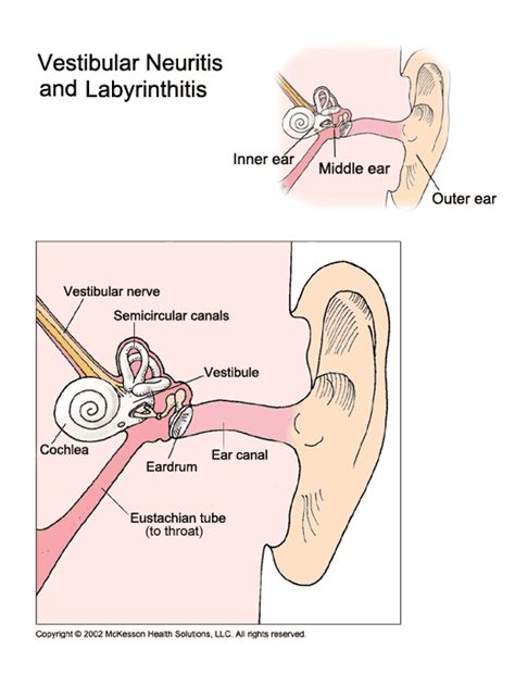 Vestibular Labyrinthitis Causes