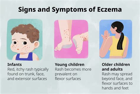 What Is Eczema Causes Signs And Symptoms Diagnosis And Treatment ...