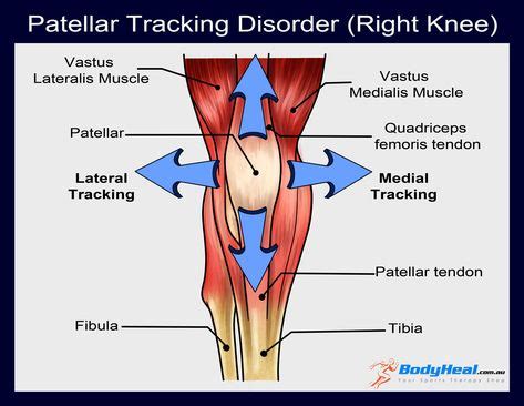 Patellar Tracking Disorder