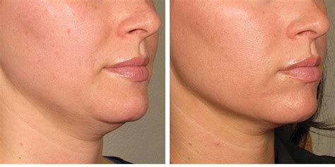 How Laser Skin Tightening Works - Radiofrequency Skin Treatment Details