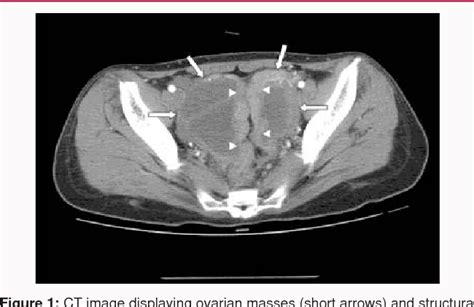 Tubo Ovarian Abscess Histology