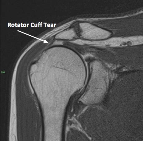 How to read mri images for a torn rotator cuff - alohadelta