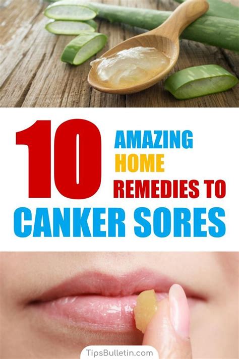 10 Amazing Homemade Solutions for Canker Sores in 2020 | Canker sore ...