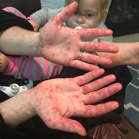 This family's experience with Hand, Foot, and Mouth disease was epic ...