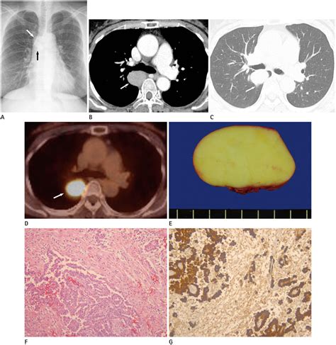 Pleural Localized Malignant Mesothelioma Mimicking a Benign Solitary ...