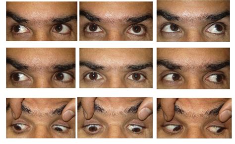 Table 1 from Paradoxical head tilt in unilateral traumatic superior ...