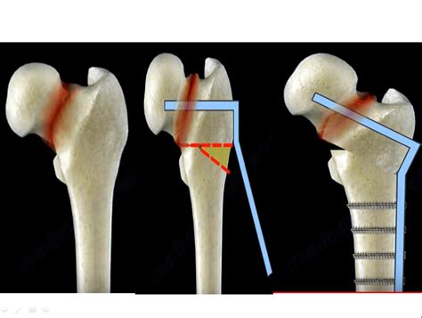 Femur Neck fracture Nonunion and Treatment — OrthopaedicPrinciples.com