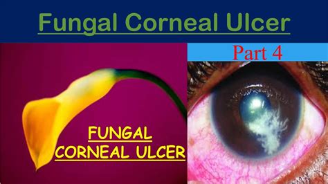 Fungal Corneal Ulcer (keratitis part 4) - YouTube