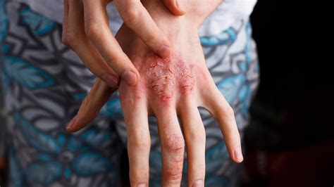 Atopic dermatitis– Symptoms and causes | National Eczema Association