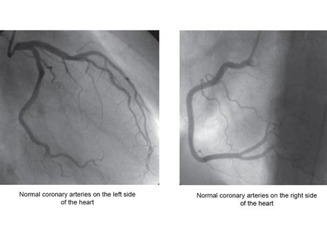 Coronary Angiography- Heart Test, Recovery & Risk - Heart Foundation