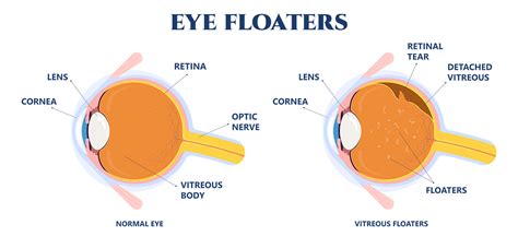 Eye Floaters | South Carolina Retina Institute