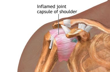 Frozen Shoulder - Symptoms and Causes