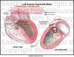 Left Anterior Fascicular Block Medical Exhibit Medivisuals