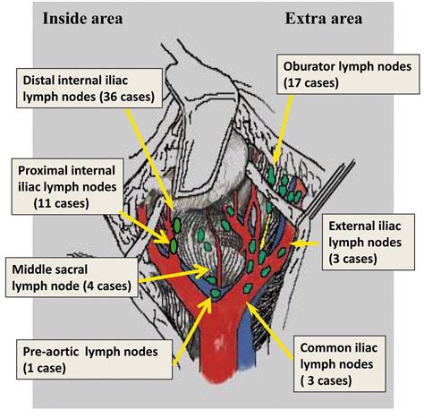 Cancer In Groin Lymph Nodes