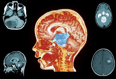 Pediatric Brain Tumors: Imaging Matters