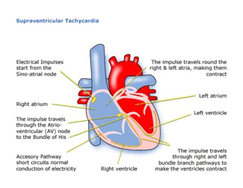 Palpitations - London Paediatric Cardiologist | Child Heart Specialist