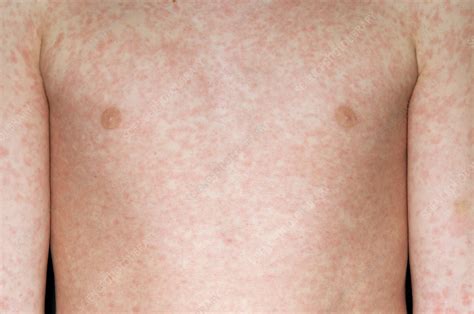 Measles rash - Stock Image - M210/0364 - Science Photo Library