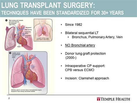 Lung Transplant Surgery: Techniques have been standardized for 30 ...