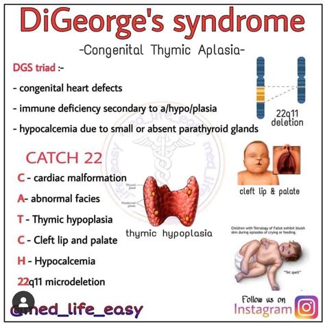 Digeorge Syndrome Facies