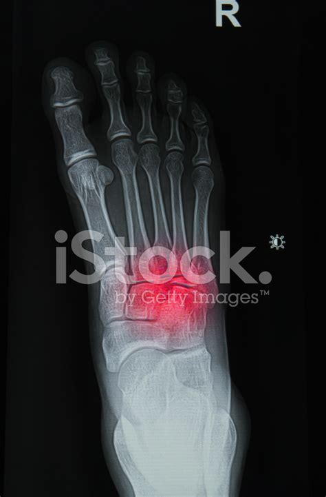 X-Rays Image Of The Painful Or Injury Foot Stock Photo | Royalty-Free ...