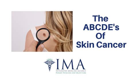 ABCDE's of Skin Cancer - Integrated Medicine Alliance