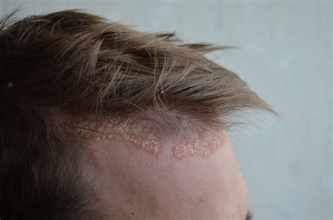 scalp psoriasis forehead hairline - Psoriasis Cure Now